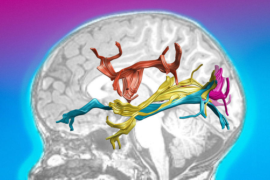 A 3D rendering of colorful nerve fiber bundles — in red, yellow, teal, and pink — overlaid on a grayscale MRI profile of a human head against a pink-to-blue gradient background.