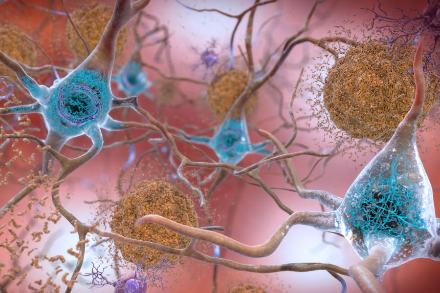 3D rendering of neurons with glowing blue cell bodies surrounded by dense orange amyloid plaque deposits against a pink neural tissue background, illustrating Alzheimer's disease pathology at the cellular level