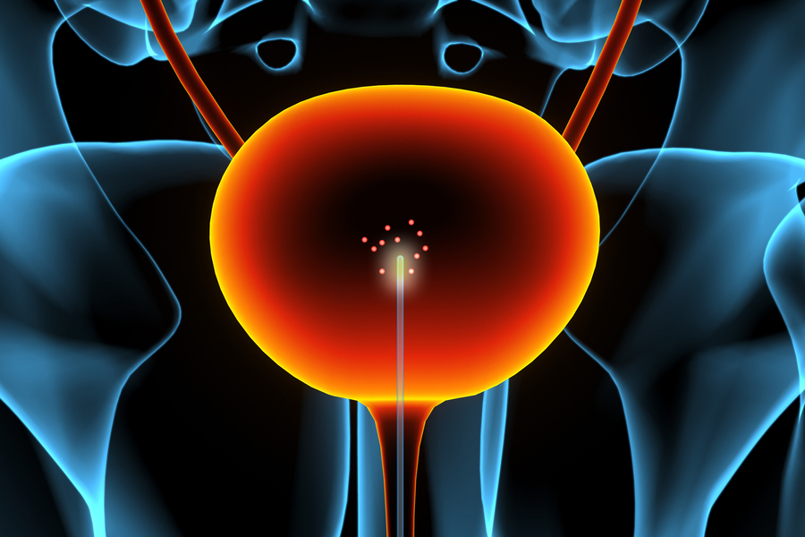 A medical illustration of a glowing orange bladder with a device inside emitting small red particles against a blue skeletal background.