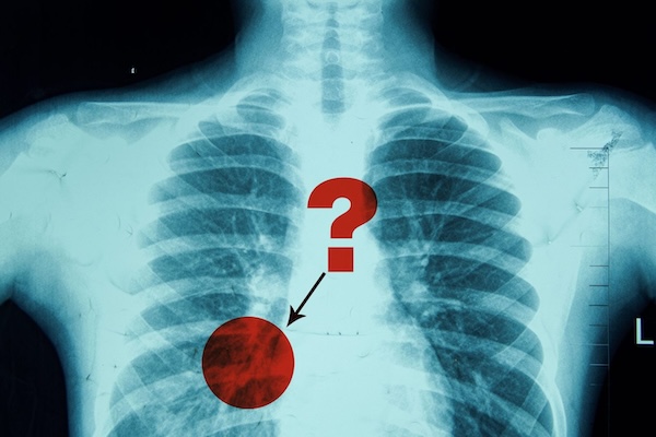 X-ray image of a chest with ribs and spine visible. A red circle and question mark highlight an area, conveying confusion or diagnosis uncertainty.