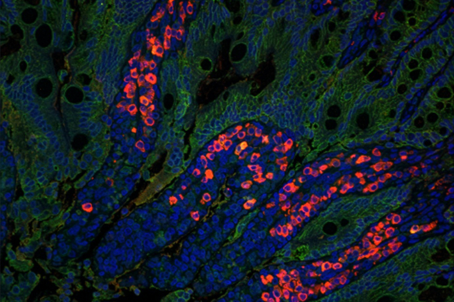 A microscopic image showing irregular clusters of bright red and orange cells interwoven with a background of blue cells.