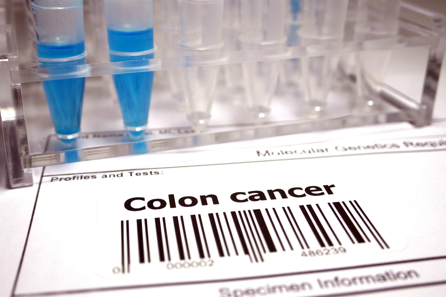 A laboratory specimen label reading "Colon cancer" with a barcode sits in front of a rack of blue-filled sample tubes.